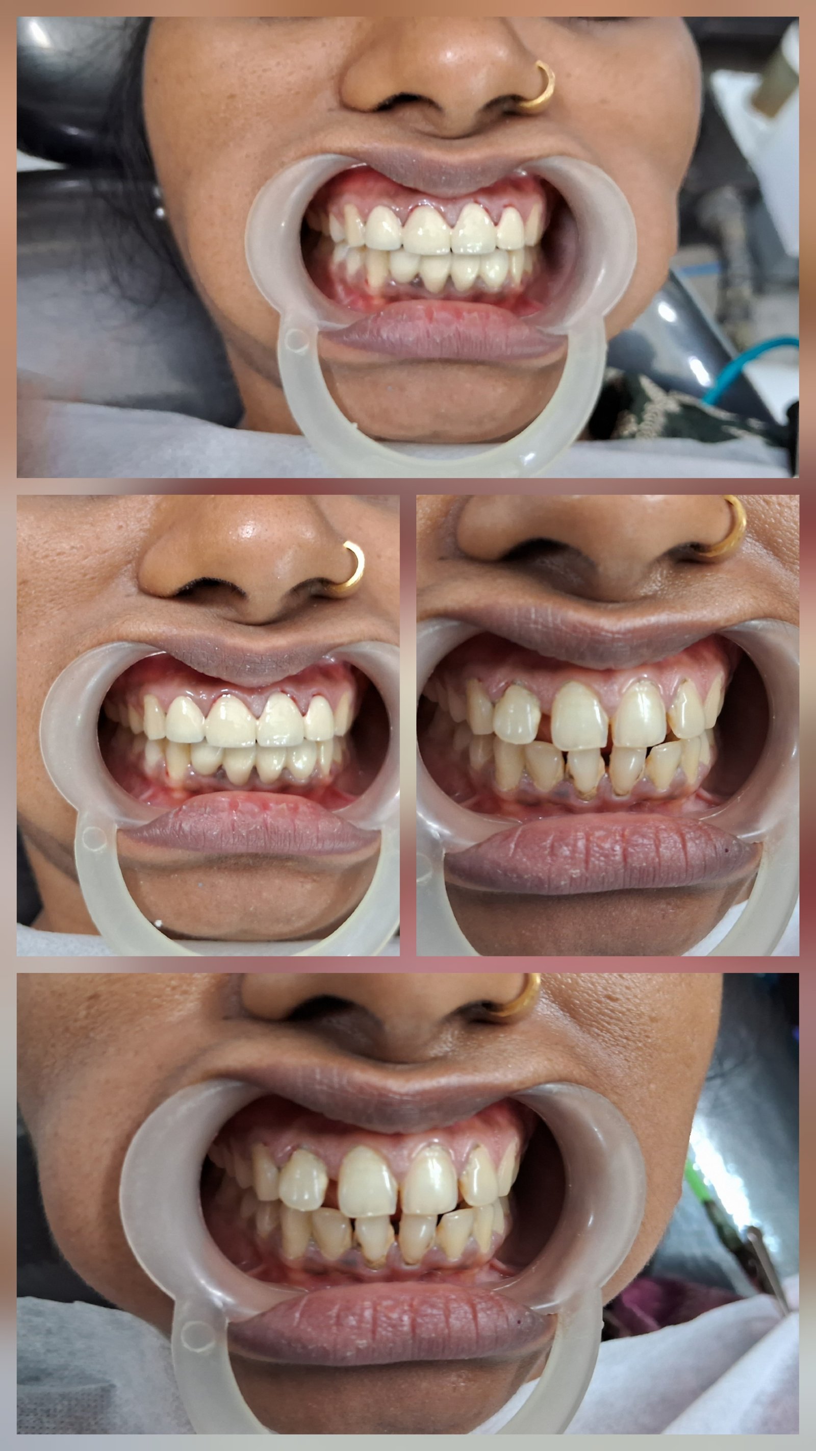 Smile transformation results